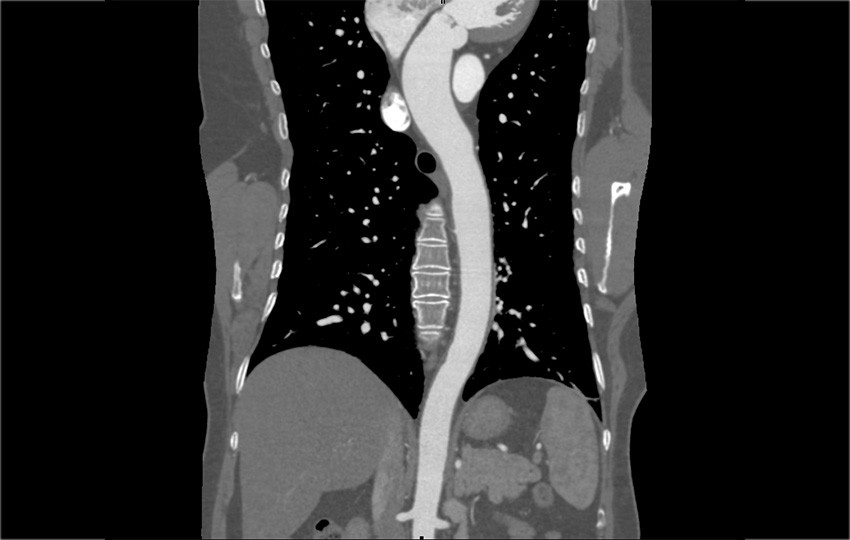 Case 1-6<br>Thoracic Aorta