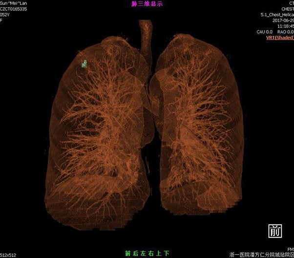 Pulmonary Nodule Analysis