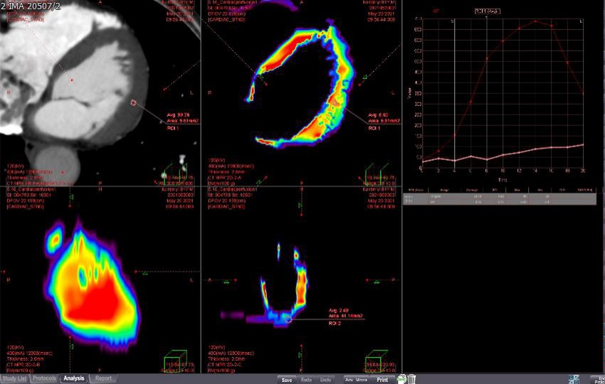 Case 3-1<br>Myocardial Perfusion