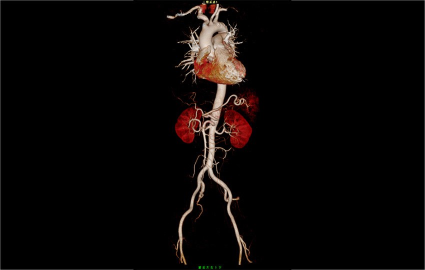 Case 1-1<br>Chest and Abdomen CTA