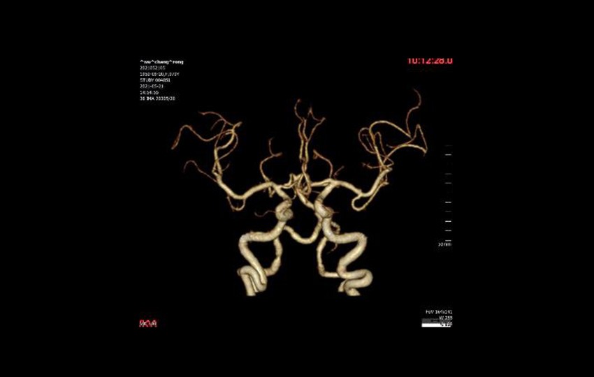 Case 2-2<br>CTA