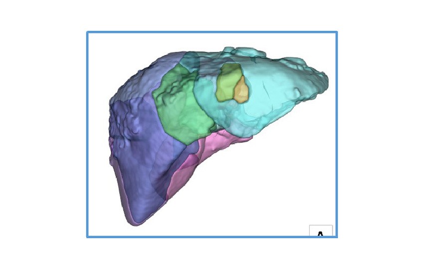 Case 1-2<br>Liver Segmentation