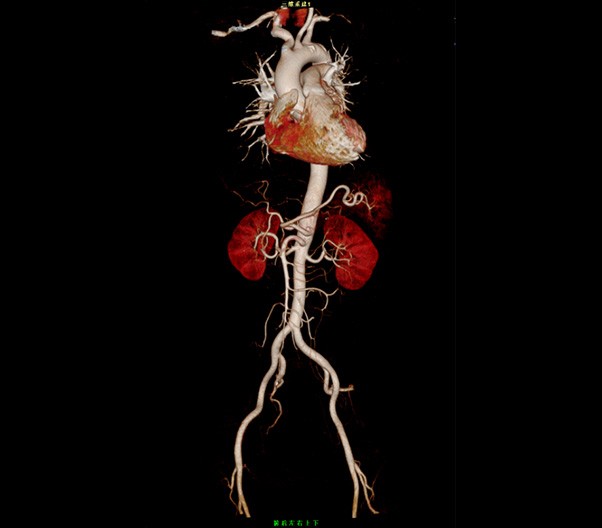 Chest and Abdomen CTA