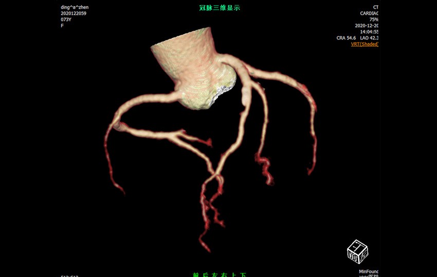 Case 1-1<br>Coronary Analysis