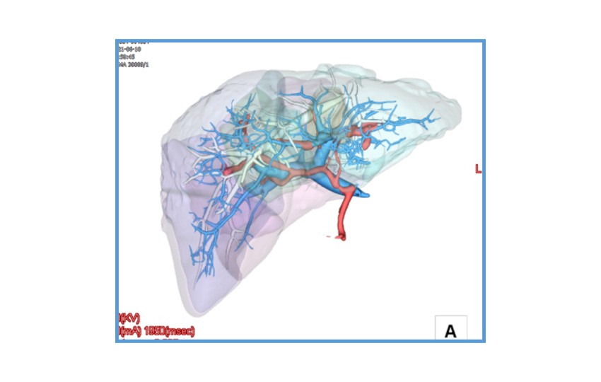 Case 1-1<br>Liver Analysis