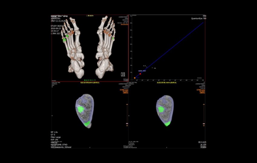 Case 2<br>Gout Crystal Detection