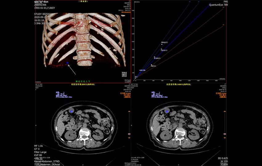 Case 1<br>Analysis of the Composition of Gallbladder Stones