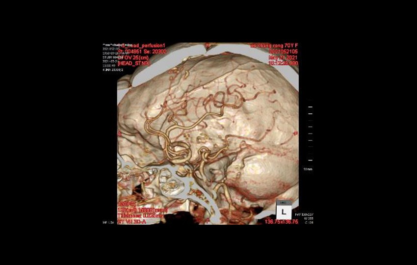 Case 2-4<br>CTA