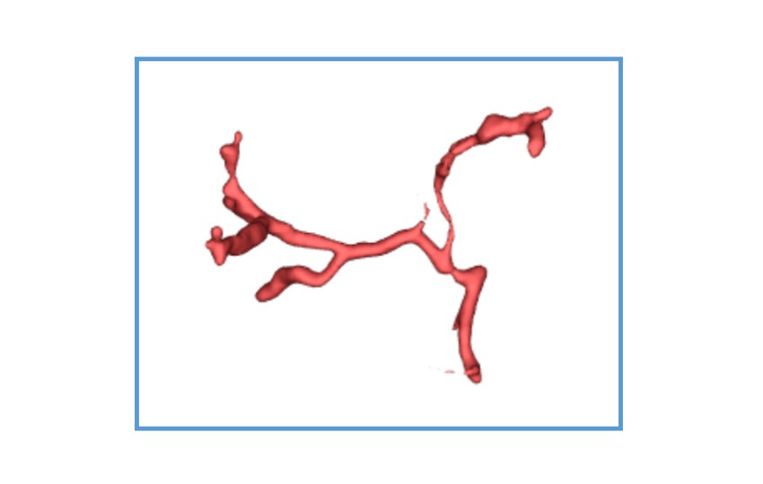 Case 1-4<br>Hepatic Artery