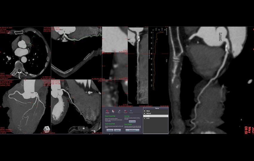 Case 3-3<br>Coronary Analysis