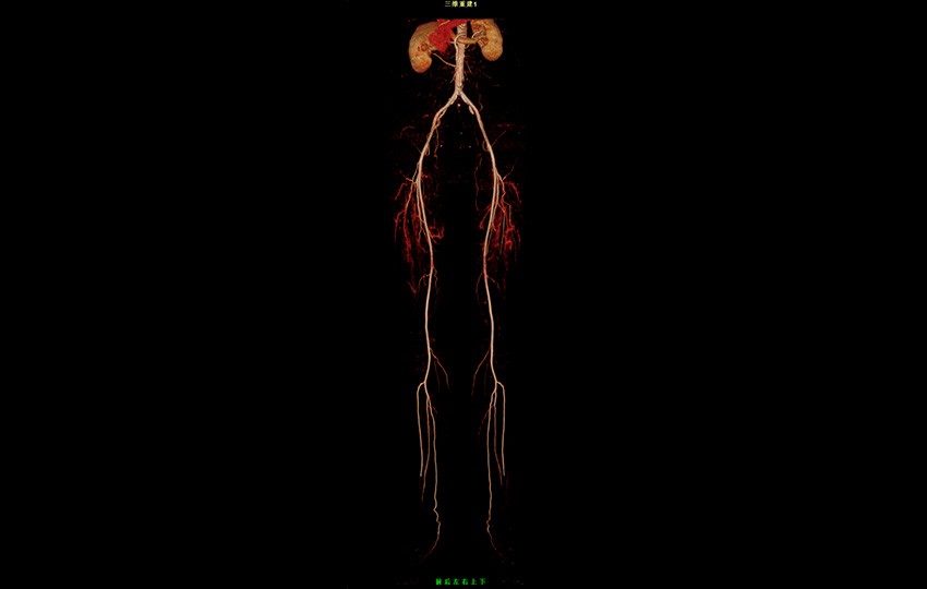 Case 1-1<br>Lower Limbs CTA