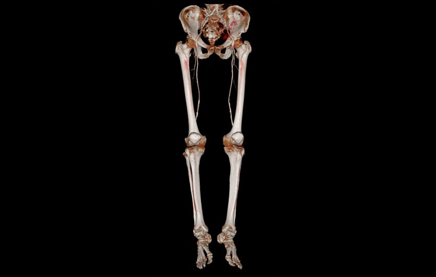 Case 1-1<br>Lower Limbs CTA