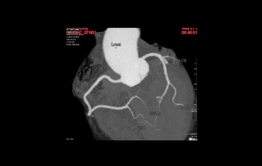 Caso 1-5<br>Arteria coronaria