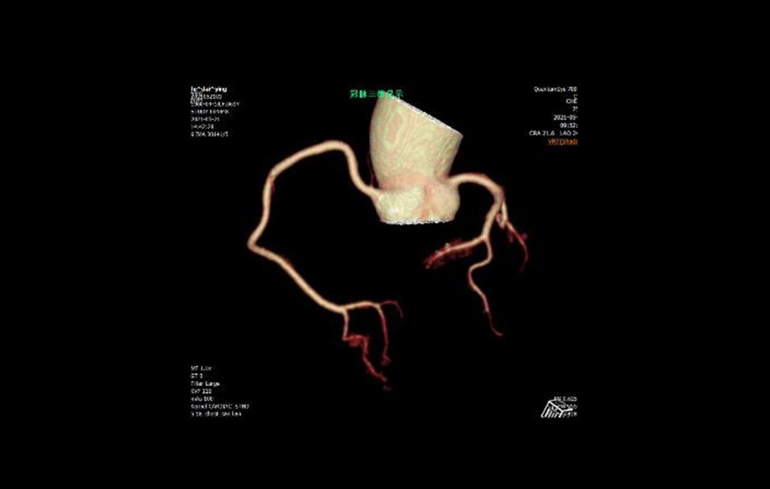 Caso 1-4<br>Arteria coronaria