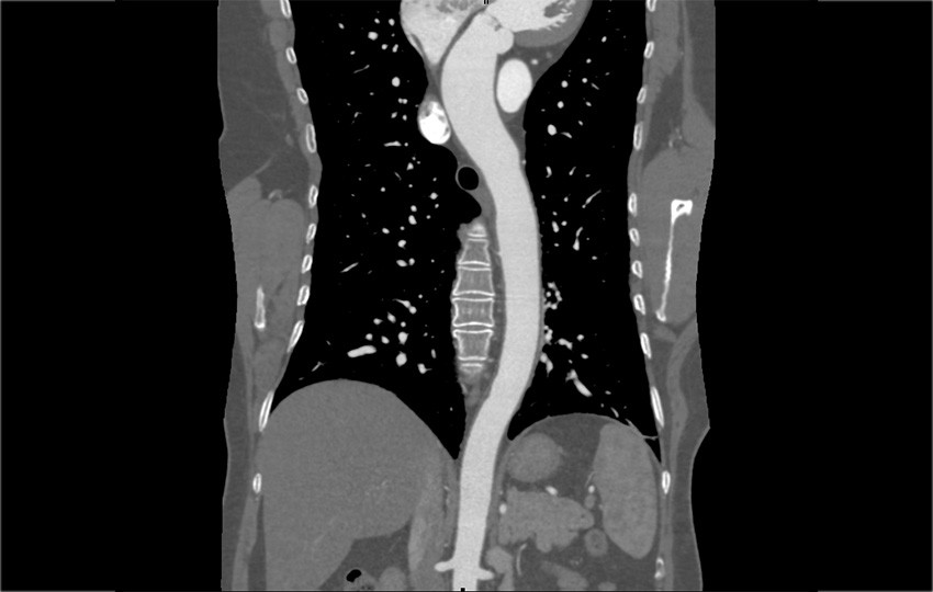 Caso 1-6<br>Aorta Toráxica 