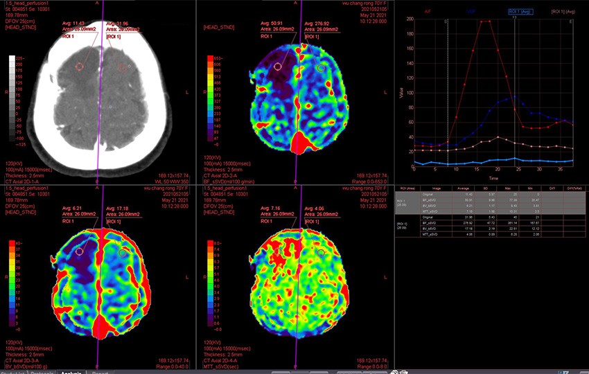 Caso 2-1<br>Perfusión cerebral