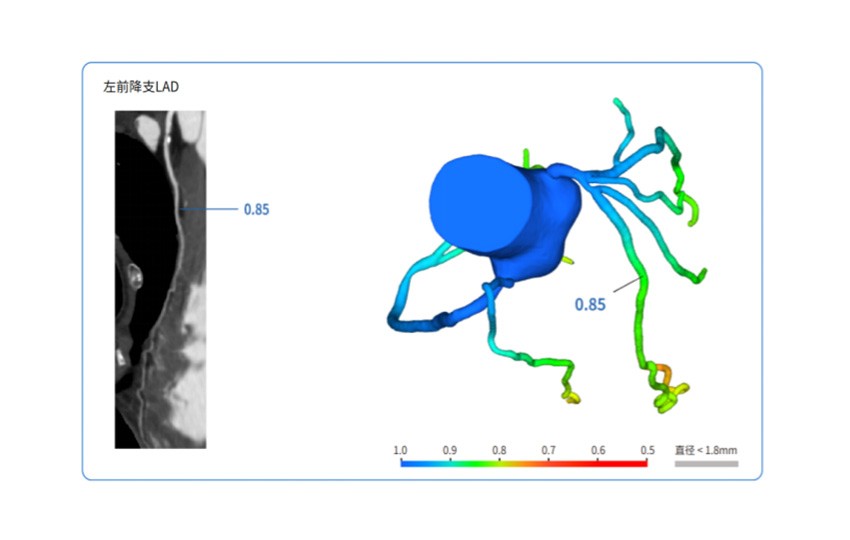 Caso 3-4<br>CT-FFR