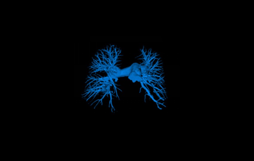 Caso 1-2<br>Arteria pulmonar