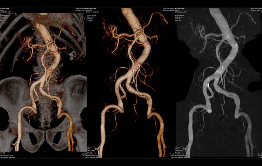 2<br>Abdomen CTA