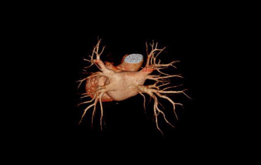 1-2<br>Veine pulmonaire